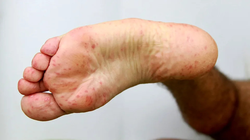 The bottom of a foot with coxsackie virus or hand foot mouth disease.