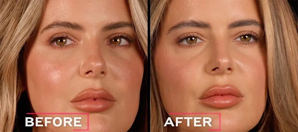 Brielle Biermann Shares Warning After Dissolving Her Under-Eye Filler