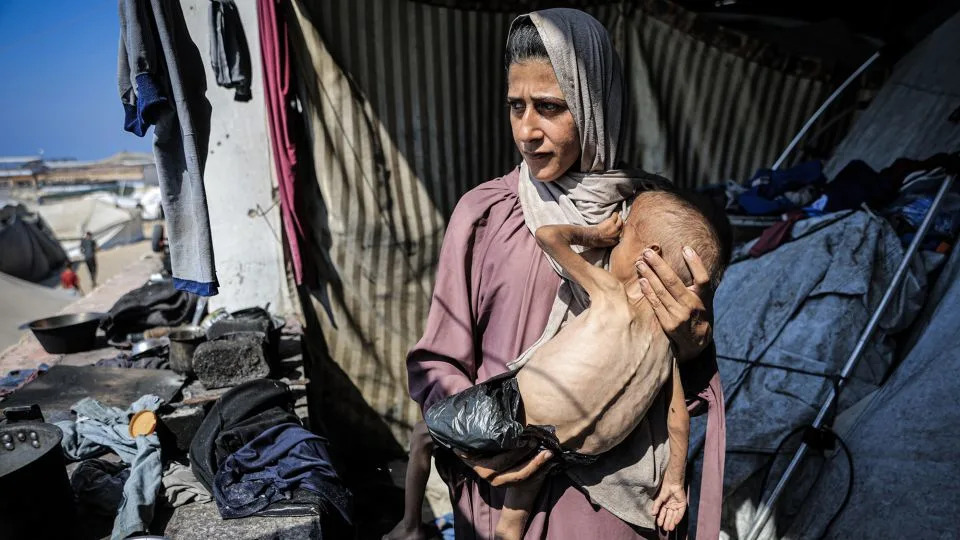 Muhammad Zakariya Ayyoub al-Matouq, a 1.5-year-old child, faces life-threatening malnutrition as the humanitarian situation worsens due to ongoing Israeli attacks and blockade in Gaza City on Monday. - Ahmed Jihad Ibrahim Al-arini/Anadolu/Getty Images