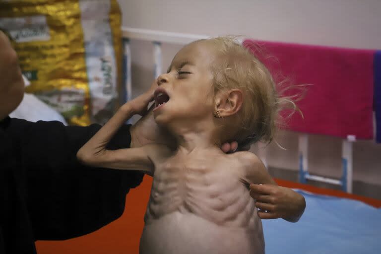 Una de las fotos tomadas por Dagga muestra a Islam Qudeih con su hija de 2 años, Shamm, gravemente desnutrida y sin camisa, a periodistas en el Hospital Nasser de Khan Younis, al sur de la Franja de Gaza, el sábado 9 de agosto de 2025.