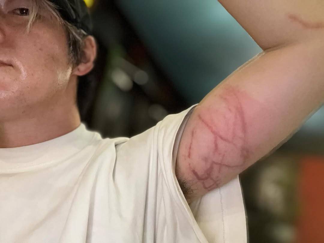 「浮いていたら…」全身腫れ上がった衝撃写真「危ないって本当なんだ」「広範囲が真っ赤」「この傷跡、何年も消えないんですよね」村本大輔が緊急搬送を告白