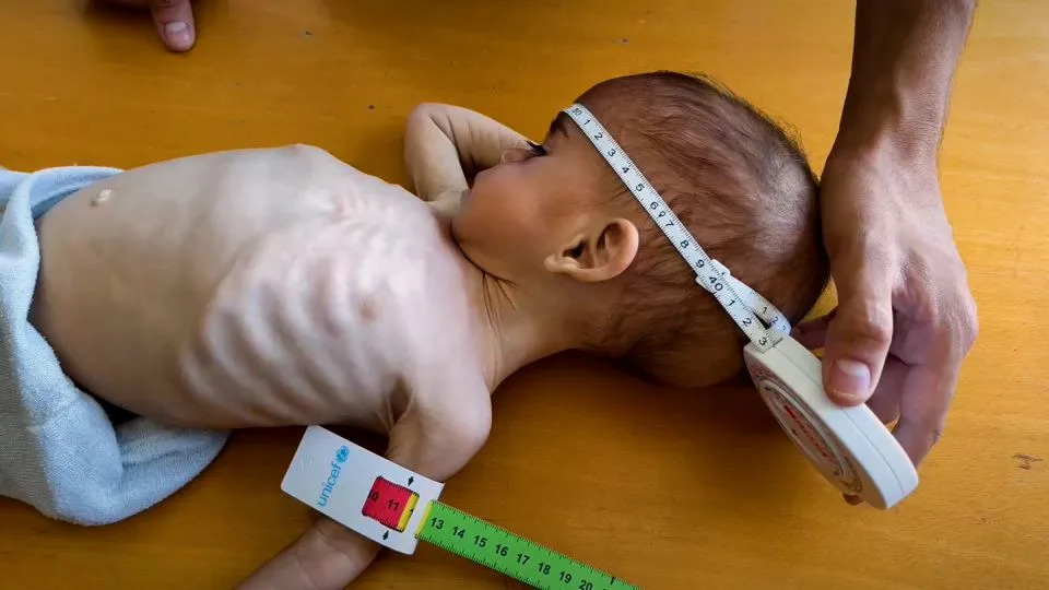 Harrowing images of starving children have driven the moves by international powers, and alarmed the White House. - UNRWA