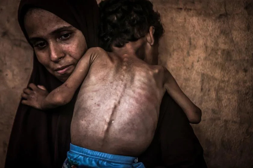 GAZA CITY, GAZA - JULY 24: 2-year-old Palestinian Yezen Abu Ful, whose health has deteriorated due to lack of access to food and nutritional supplements, is seen with his mother in the Al-Shati Refugee Camp in Gaza Strip on July 24, 2025. Food shortages caused by Israeli attacks and the deepening humanitarian crisis are threatening the life of 2-year-old Yezen Abu Ful. Living under harsh conditions in the Al-Shati Refugee Camp in western Gaza City, the Abu Ful family has issued a plea for help for their struggling child. (Photo by Ali Jadallah/Anadolu via Getty Images)