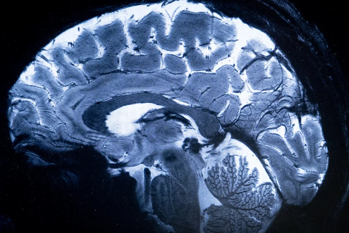 Breakthrough study finds deficiency of this common nutrient could contribute to Alzheimer’s