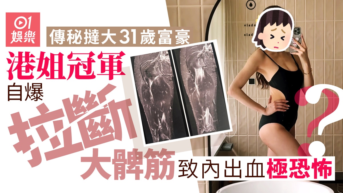 港姐冠軍傳秘撻富豪後曝光率極低　自爆拉斷大髀筋致內出血好恐怖