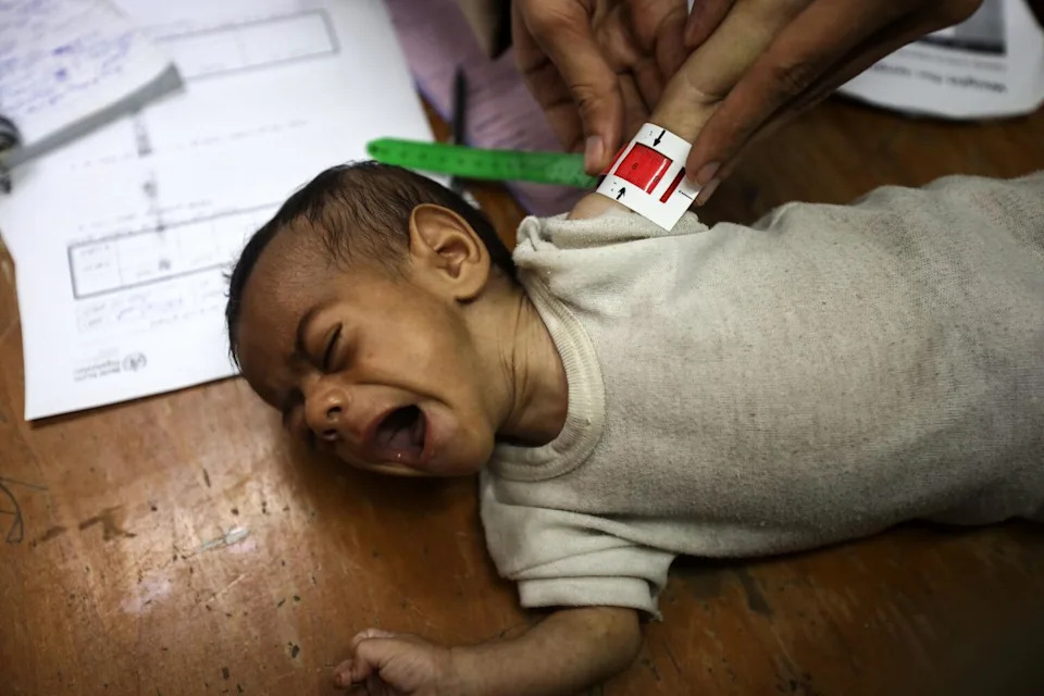 A Palestinian girl suffers from malnutrition and is measured while receiving treatment.