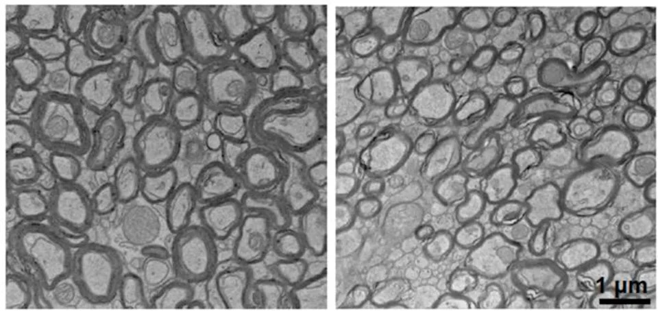 Lithium deficiency thinned the myelin that coats neurons (right) compared to normal mice (left) (Yankner Lab)