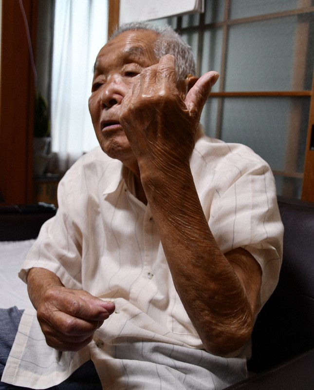 沖縄戦に兵士として送られた山下和明さん。左ひじには米軍の手投げ弾の破片が今も残っている＝大分県国東市で2025年8月5日午後6時28分、遠藤孝康撮影