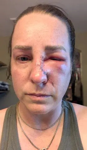 Amanda Anderson / SWNS Amanda Anderson undergoes surgery after skin cancer diagnosis