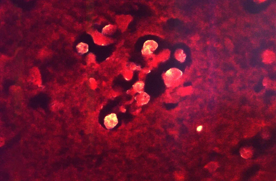 A handout photomicrograph provided by the Centers for Disease Control and Prevention (CDC) depicts characteristics associated with a case of a rare brain infection known as primary amebic meningoencephalitis due to Naegleria fowleri parasites, a type of brain-eating amoeba.