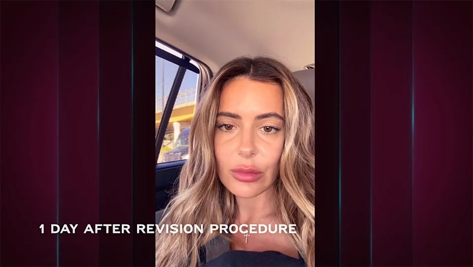 Brielle Biermann, Botched Presents: Plastic Surgery Rewind