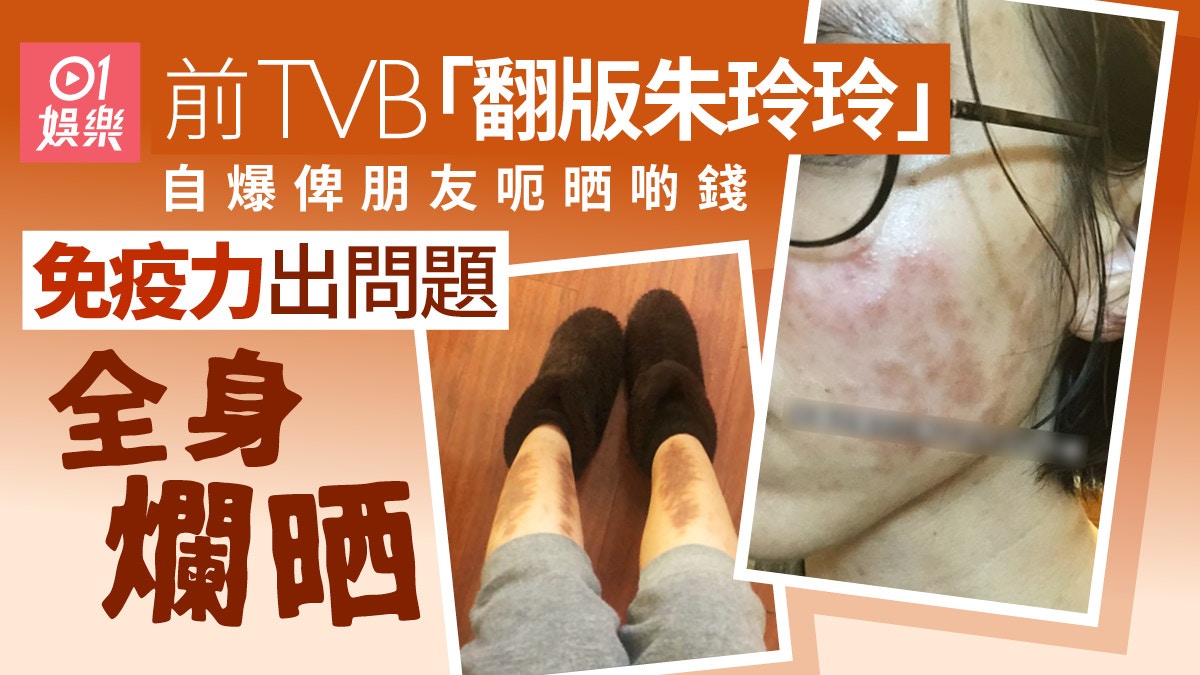 前TVB「翻版朱玲玲」自爆俾朋友呃晒啲錢　免疫力出問題全身爛晒