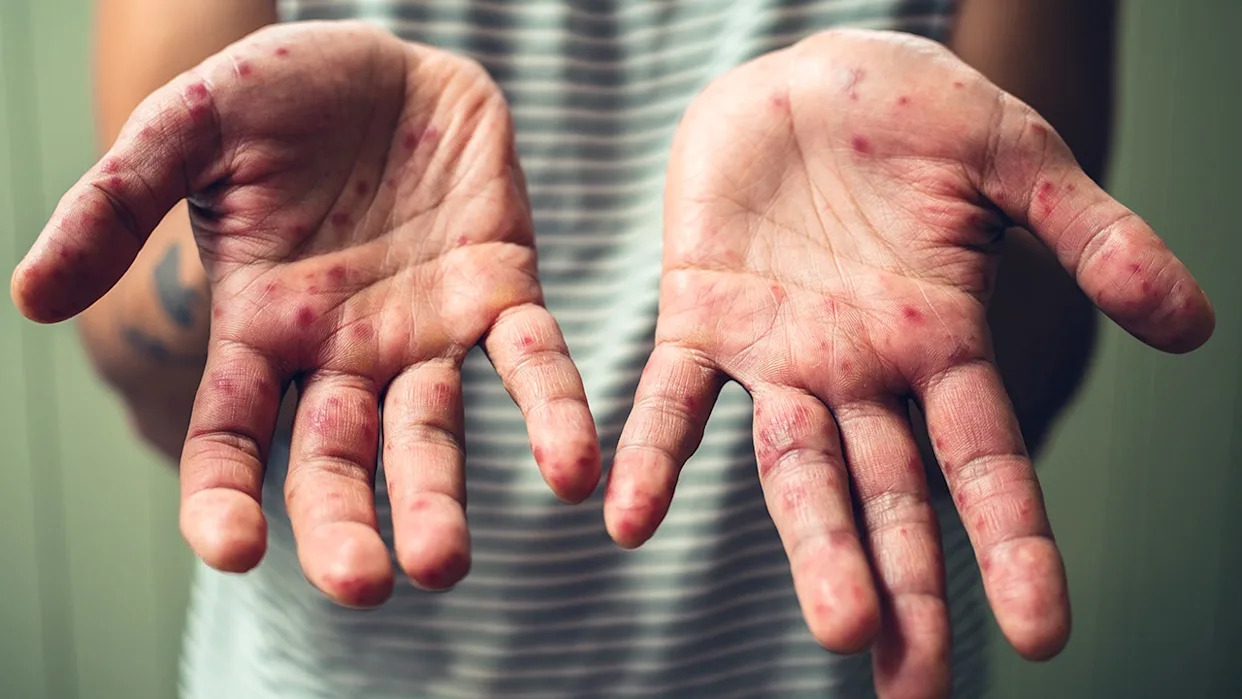 Highly contagious disease surges in some US states amid report of possible fatal case