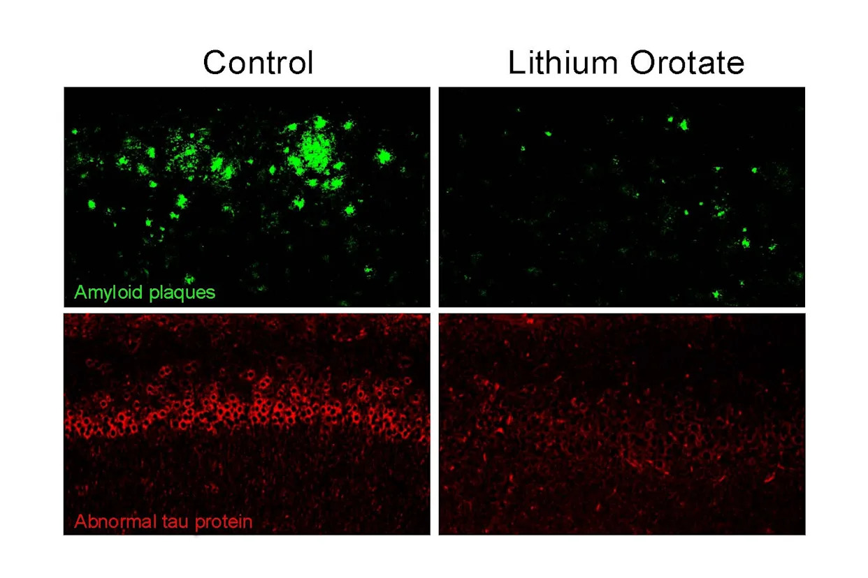 Research on reversing Alzheimer’s reveals lithium as potential key