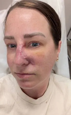 Amanda Anderson / SWNS Amanda Anderson undergoes surgery after skin cancer diagnosis