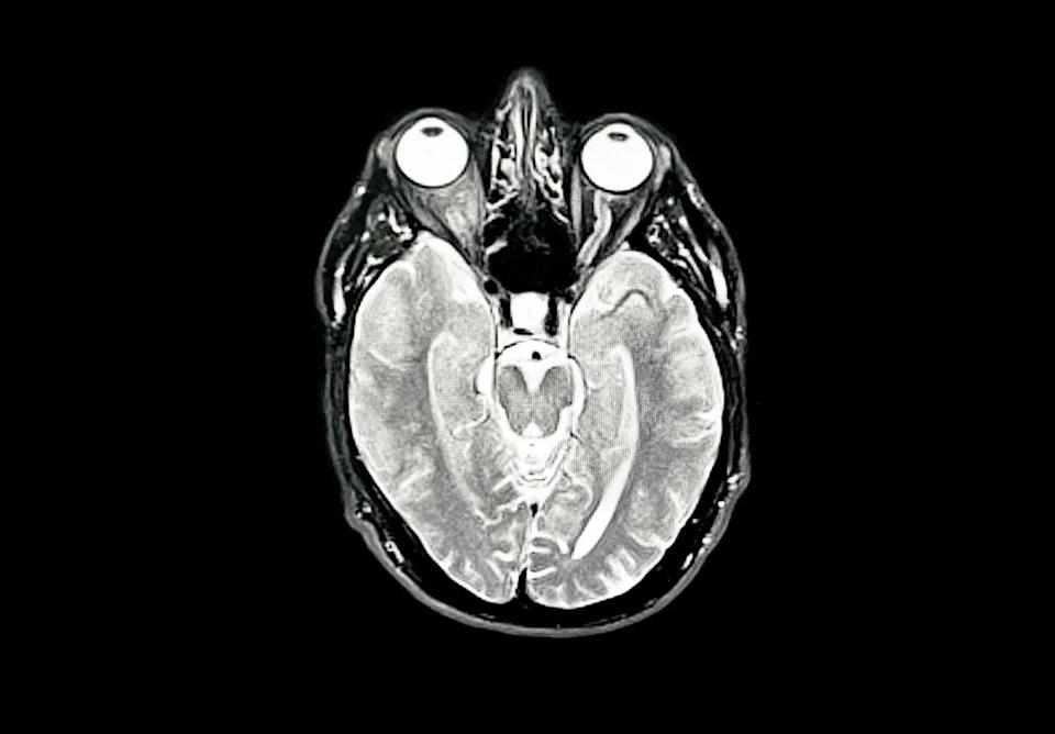 Brain image of early Alzheimer's disease
