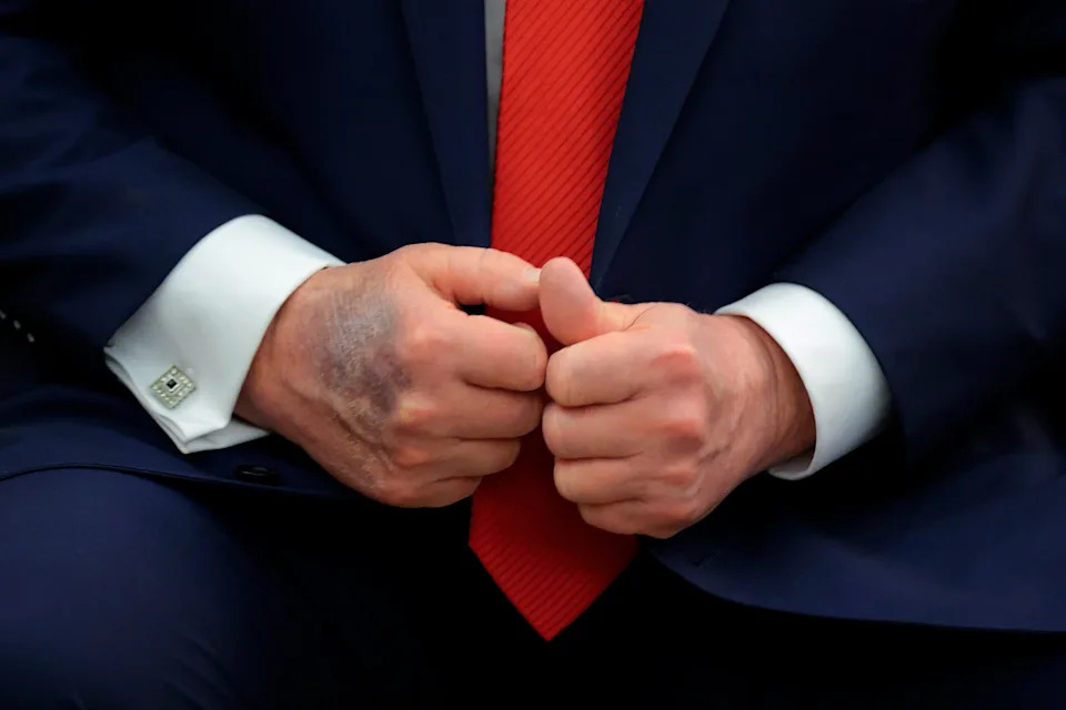 President Donald Trump tried to keep the bruise on his right hand out of view Monday. The White House has said it was the result of too much handshaking. / Chip Somodevilla/Getty Images