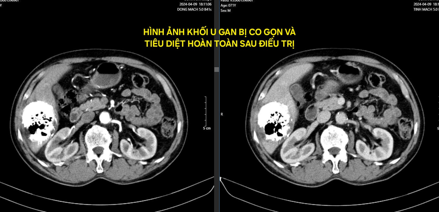 Kết quả bất ngờ sau 5 tháng đối diện với ung thư giai đoạn cuối