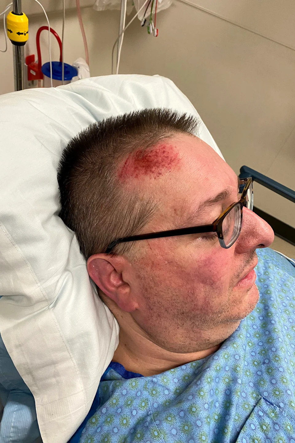 John Karadell with a large abrasion on his head. (Courtesy Emily Steiner)