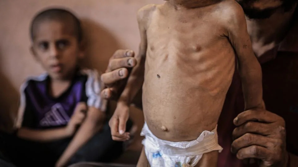 Two-year-old Yezen Abu Ful continues to lose weight as his condition worsens due to severe food shortages caused by the blockade and Israeli attacks, in Gaza City, Gaza on July 13. - Ahmed Jihad Ibrahim Al-arini/Anadolu/Getty Images