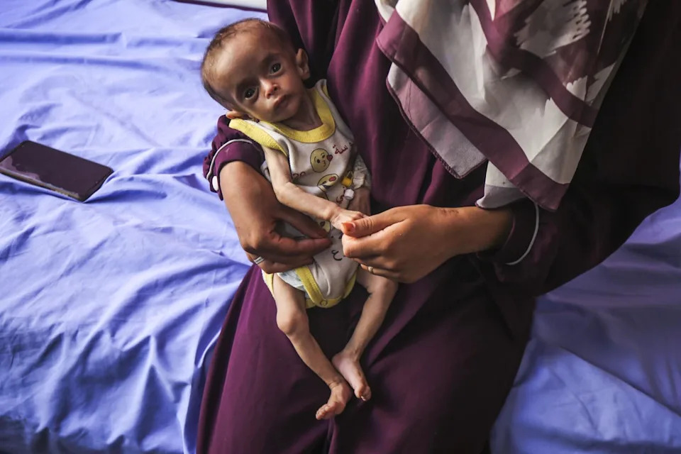An exhausted, weak and malnourished child is seen along with his mother.
