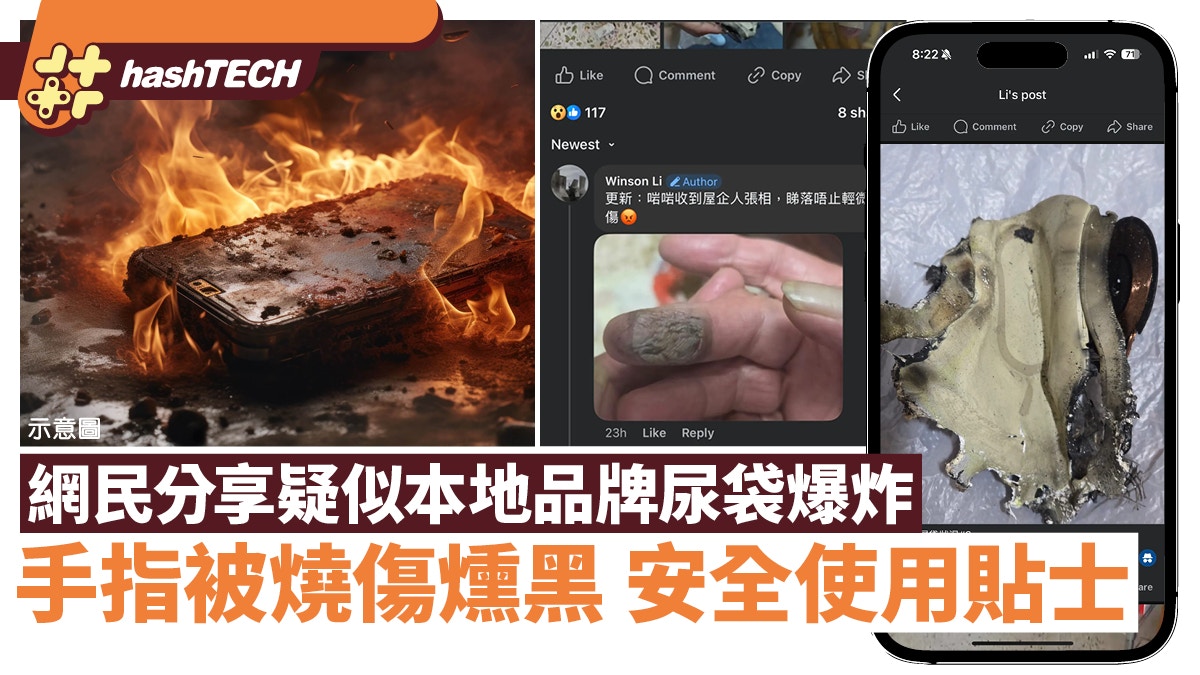本地品牌尿袋爆炸？｜網民手指被燒傷燻黑　安全使用貼士