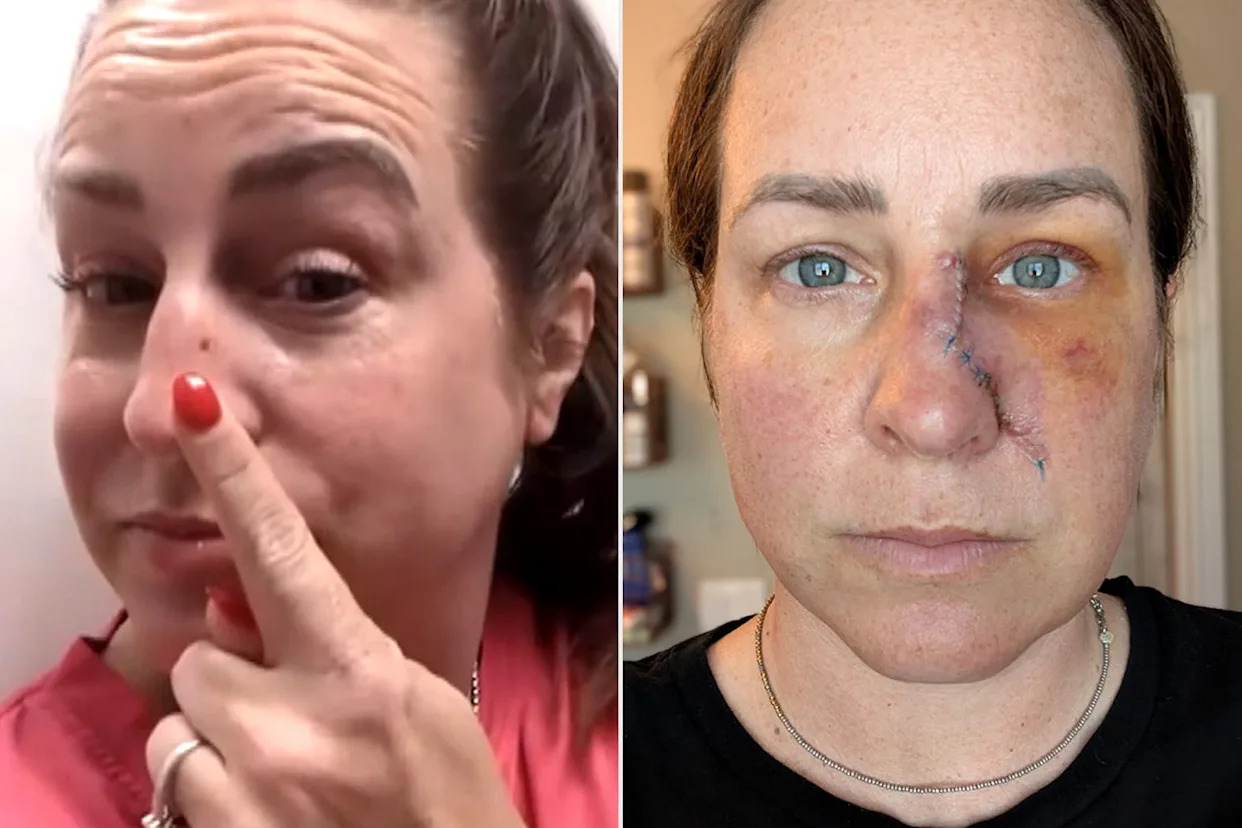 Mom Thought She Just Had Dry Skin. Months Later, She Had Hole 'The Size of a Quarter' in Her Nose After Skin Cancer Diagnosis