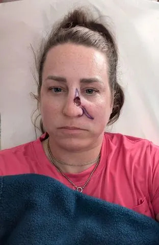Amanda Anderson / SWNS Amanda Anderson undergoes surgery after skin cancer diagnosis