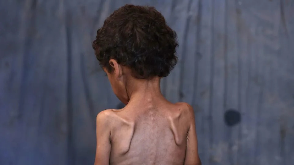 Yazan, a malnourished 2-year-old Palestinian boy, stands with his back turned in his family's damaged home in the Al-Shati refugee camp, west of Gaza City, on July 23. - Omar al-Qatta/AFP/Getty Images