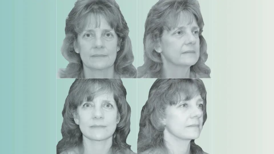 Kimberly Bongiorno fotografiada antes (arriba) y después (abajo) de su lifting facial y de cuello. - ilustrativa/CNN/Berlet Plastic Surgery
