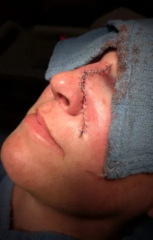 SWNS Amanda Anderson undergoes surgery after skin cancer diagnosis