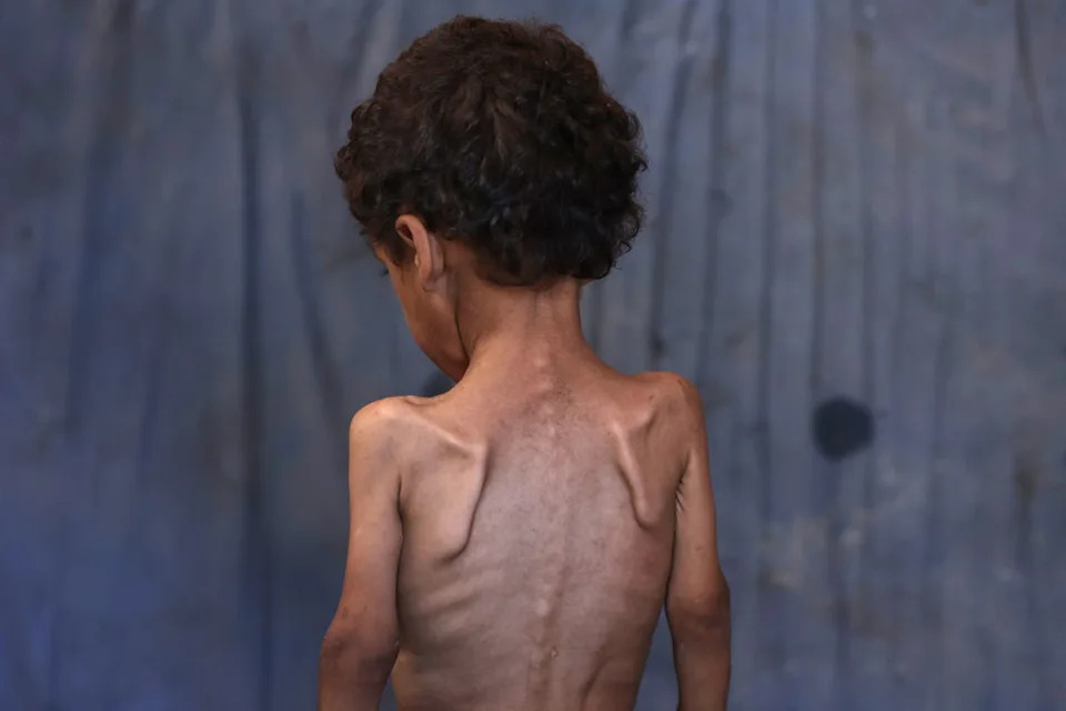 Yazan, a malnourished 2-year-old Palestinian boy, in his family's damaged home in the Al-Shati refugee camp, west of Gaza City (AFP via Getty Images)