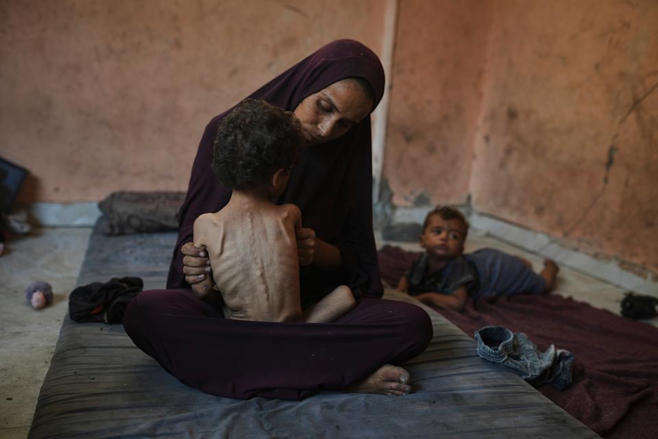 Naima Abu Ful sostiene a su hijo desnutrido de dos años, Yazan, en su casa en el campo de refugiados de Shati, en la ciudad de Gaza, el miércoles 23 de julio de 2025. (Foto AP/Jehad Alshrafi)