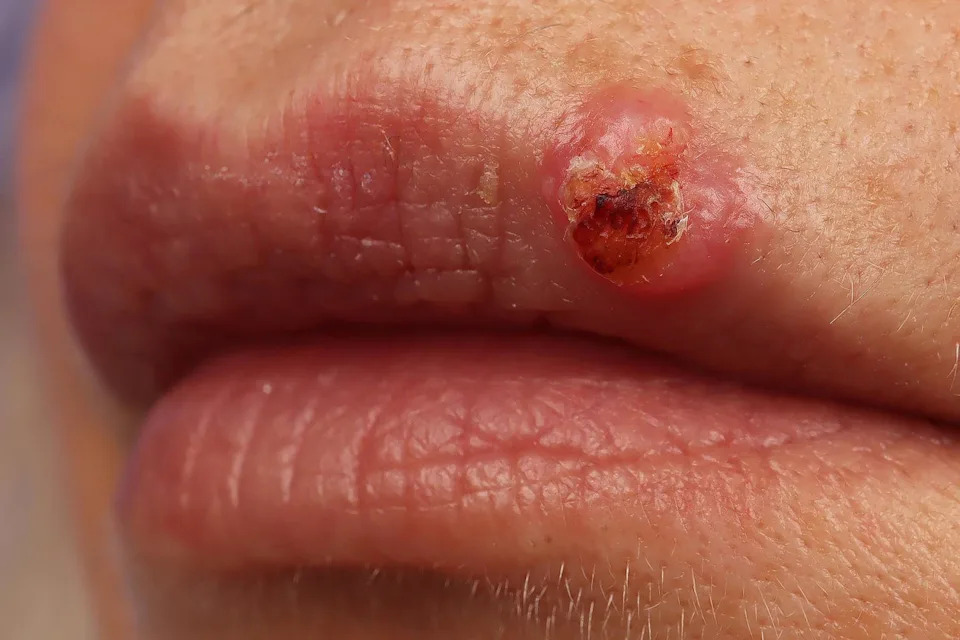 Squamous cell carcinoma (BSIP / Universal Images Group via Getty Images)
