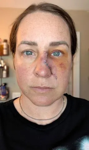 Amanda Anderson / SWNS Amanda Anderson undergoes surgery after skin cancer diagnosis