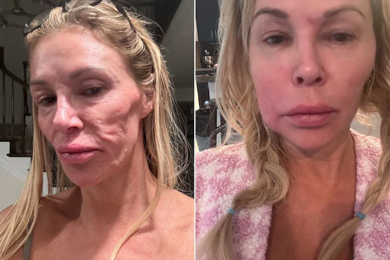 Brandi Glanville Says She's 'Finally Getting Answers' amid Facial 'Parasite' Crisis