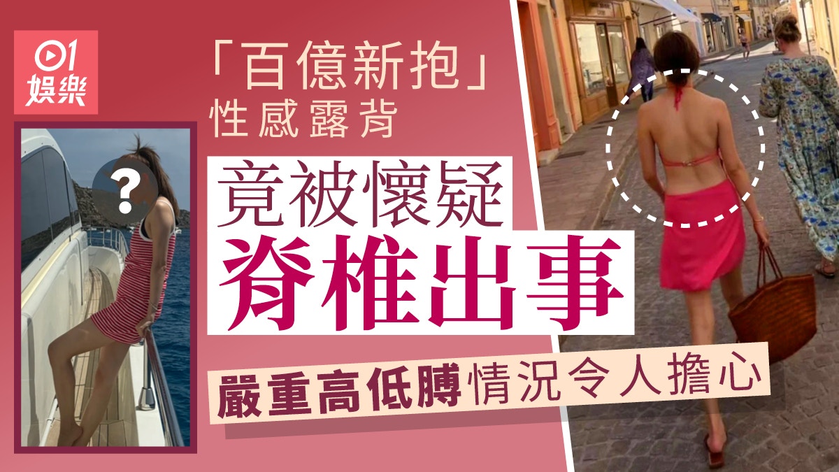 「百億新抱」性感露背竟被懷疑脊椎出事　嚴重高低膊情況令人擔心