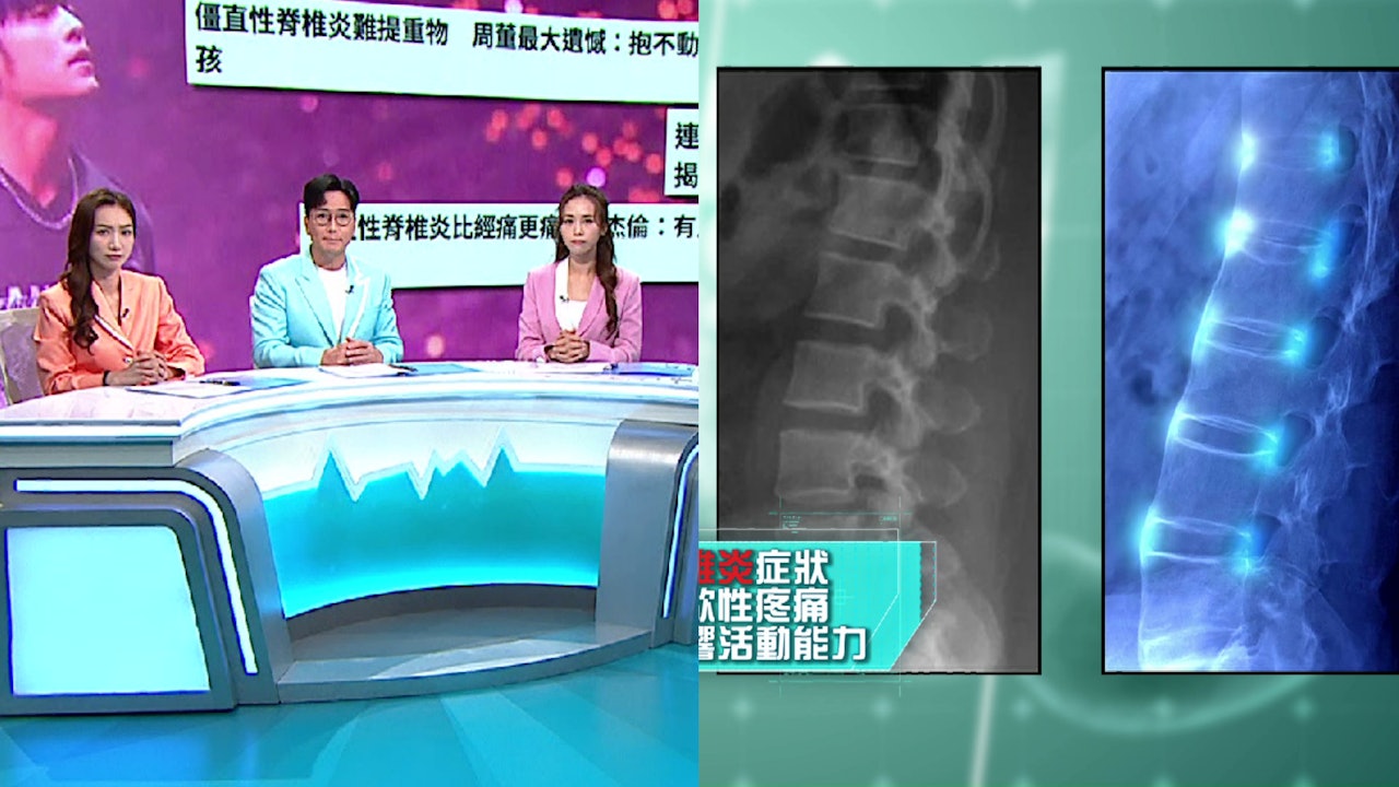 健康新聞報道｜周杰倫受「強直性脊椎炎」困擾　曾狂食止痛藥止痛