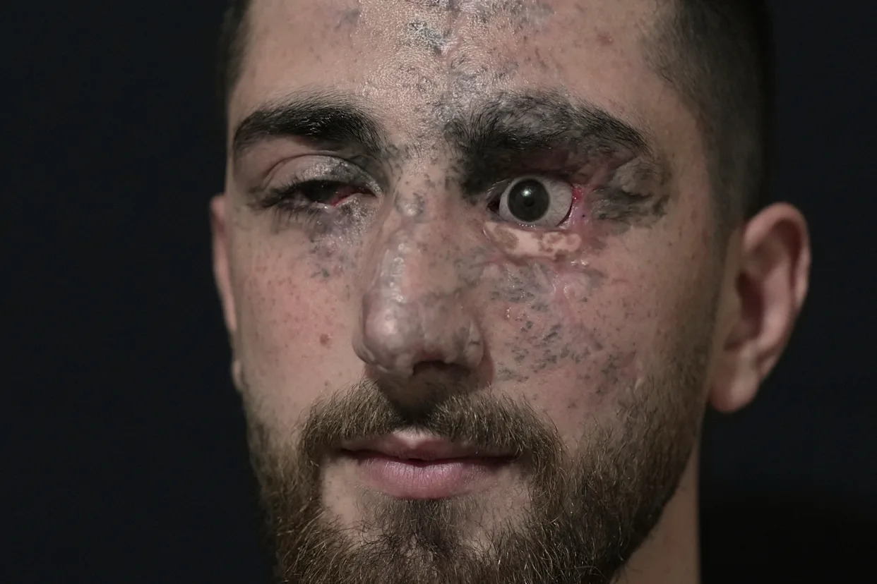 PHOTO ESSAY: Portraits of survivors of Israel's pager attack on Hezbollah last year