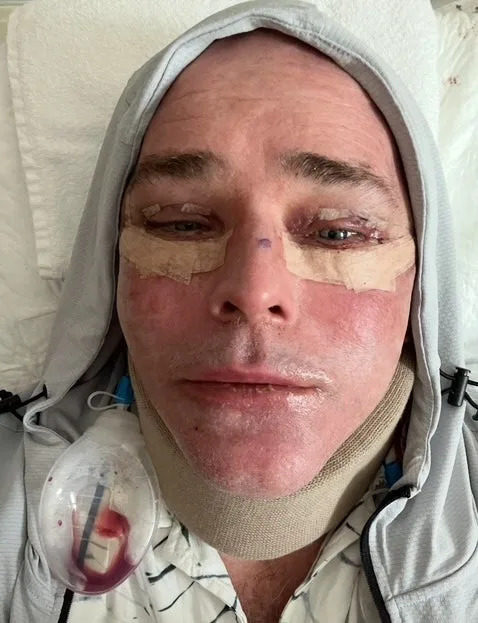 Person lying down, wearing a neck brace and hoodie, with medical tape on face and a drainage tube. Appears to be recovering from a medical procedure