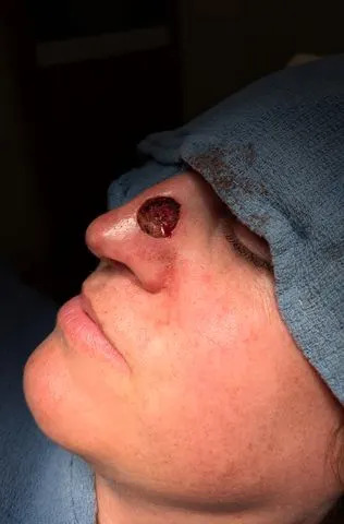 SWNS Amanda Anderson undergoes surgery after skin cancer diagnosis